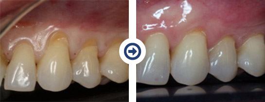 before and after pinhole surgical technique procedure 1 of 6