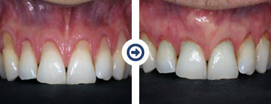 before and after pinhole surgical technique procedure 2 of 6