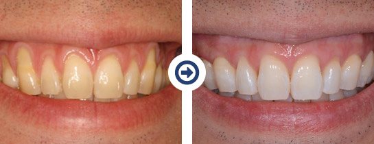 before and after pinhole surgical technique procedure 3 of 6