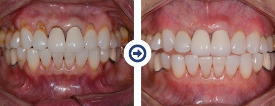 before and after pinhole surgical technique procedure 4 of 6