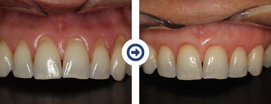 before and after pinhole surgical technique procedure 5 of 6
