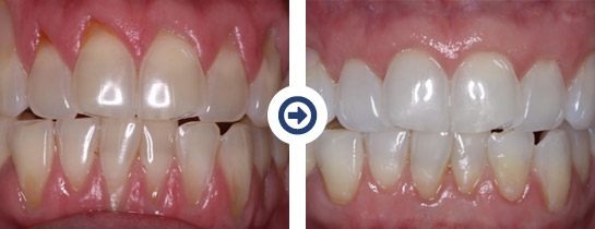 before and after pinhole surgical technique procedure 6 of 6