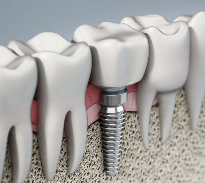 cross section vector image of a dental implant among tooth roots.