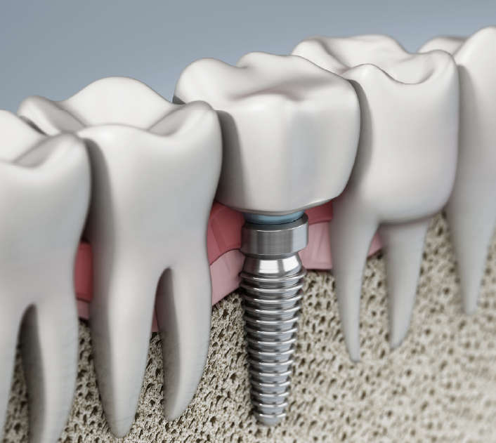 Vector image of a dental implant and teeth roots cross section under the gum line.