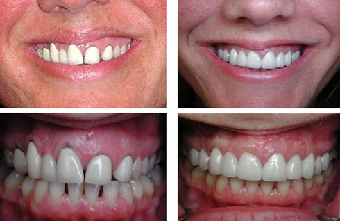 Before and after cosmetic periodontal procedures