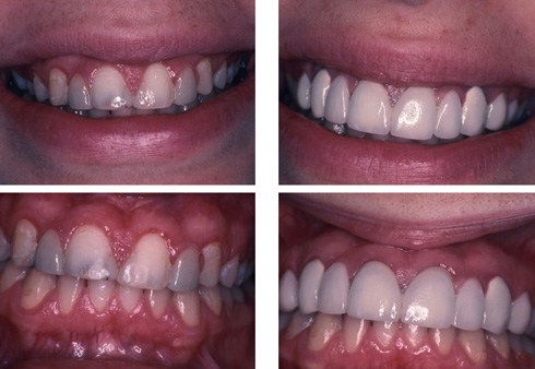 Before and after cosmetic periodontal procedures
