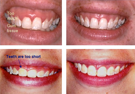 Before and after gingivectomy gummy smile treatment with Dr. Scharf