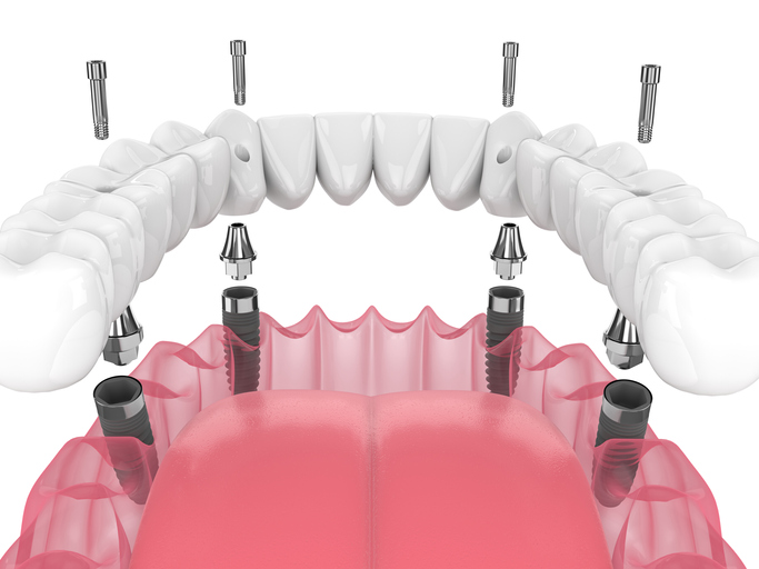 Mandibular prosthesis all on 4 system supported by implants over white background
