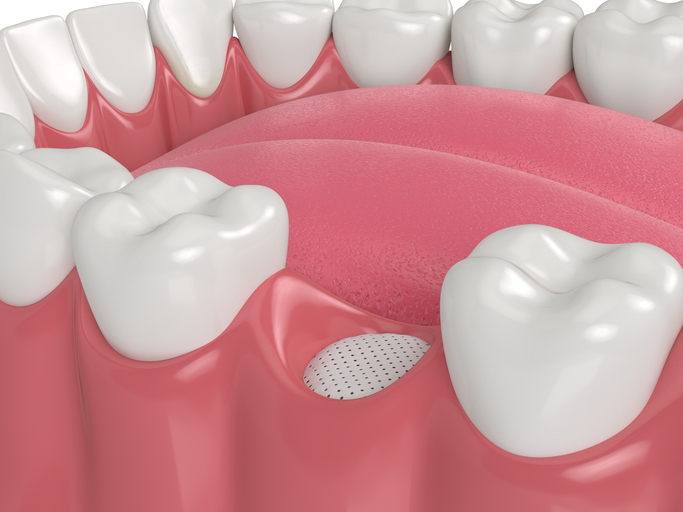 3D render of dental bone grafting with membrane
