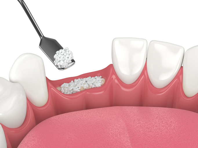 3D render of dental bone grafting with dental bone biomaterial.