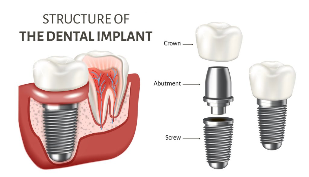 cross section of a dental implant and parts - 3D rendering