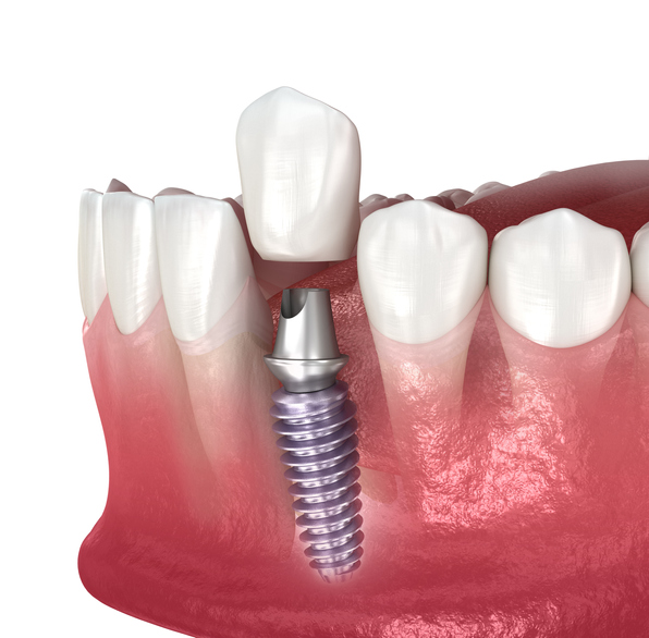 dental implant and ceramic crown 3D rendering