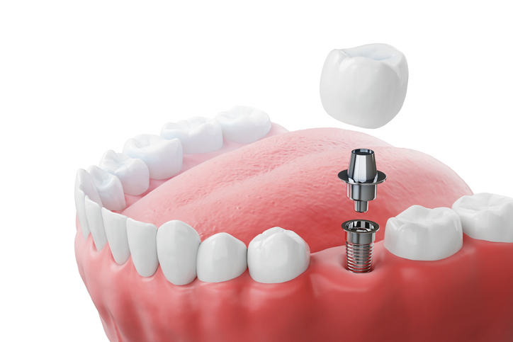 Dental implantation, teeth with implant screw, 3d illustration.