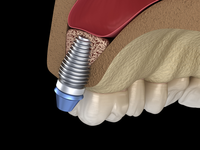 Sinus Lift Surgery - implant installation. 3D illustration
