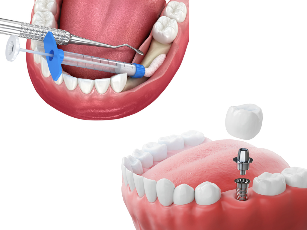 bone graft for dental implant vector