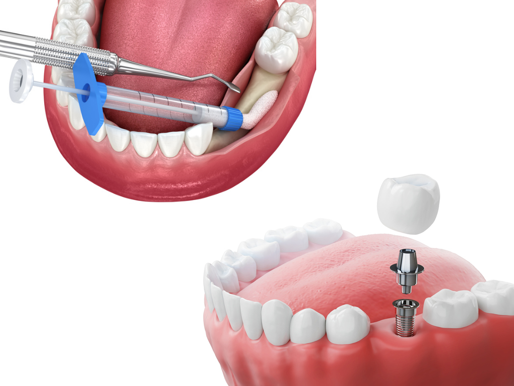 Bone grafting for dental implants