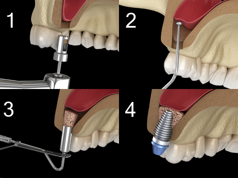 Sinus Lift vs. Bone Graft Differences and Similarities