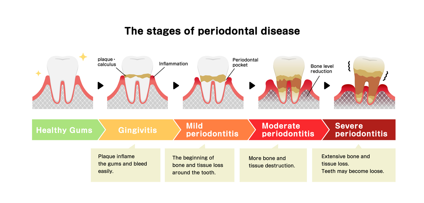 stages of gum disease