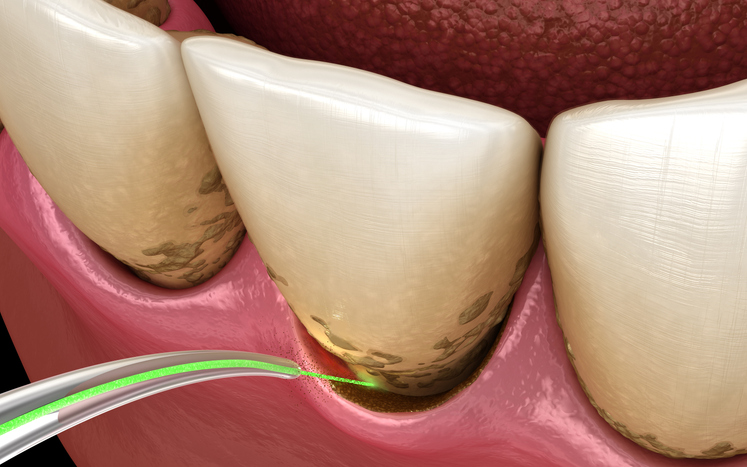 mt-20 perio laser to deep clean teeth