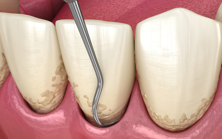 scaling and root planing to deep clean teeth