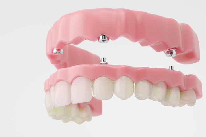 implant-supported dentures on a white background