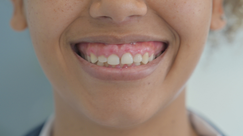 woman with a gummy smile