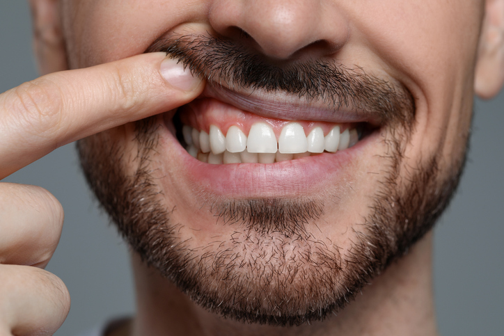 man showing the shape of his gums