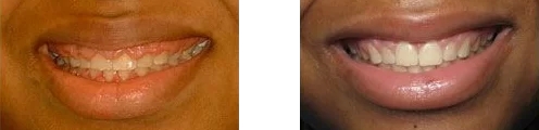 Gummy smile before and after treatment