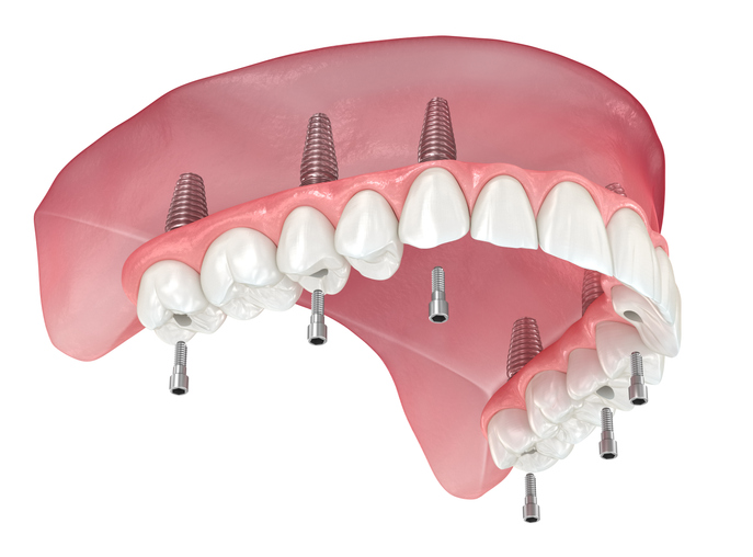 All on X Dental Implants: A Life Changing Solution for Full Arch Tooth Replacement