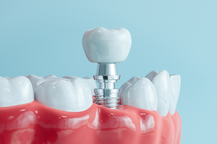 Are You a Candidate for Dental Implants If You Have Gum Disease?