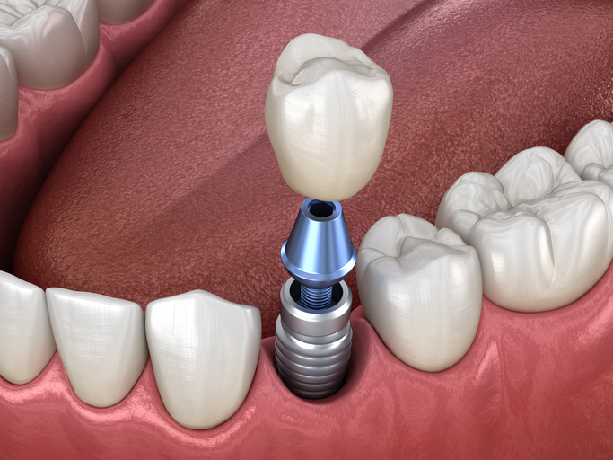 3D illustration of dental implant, abutment and crown.