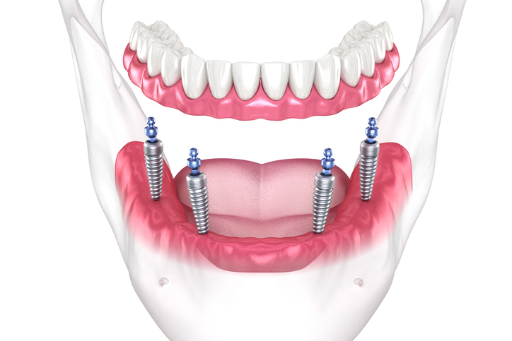 All on 4 dental implants with ball attachments. Medically accurate dental 3D illustration.
