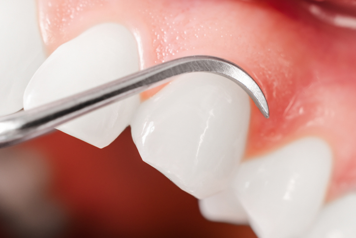 Periodontal Surgery or Nonsurgical Care: How Your Treatment Plan Is Decided