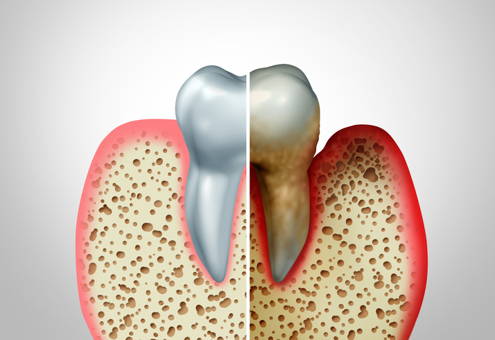 Can Gum Disease Be Reversed? Gingivitis vs. Periodontitis